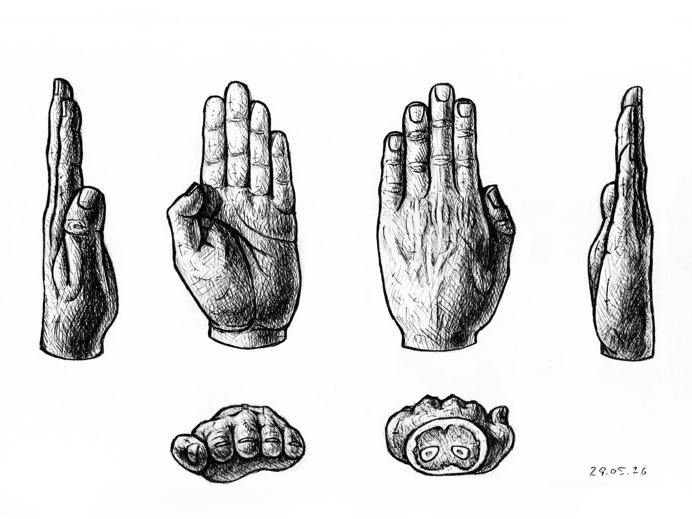 Wurstfingersyndrom